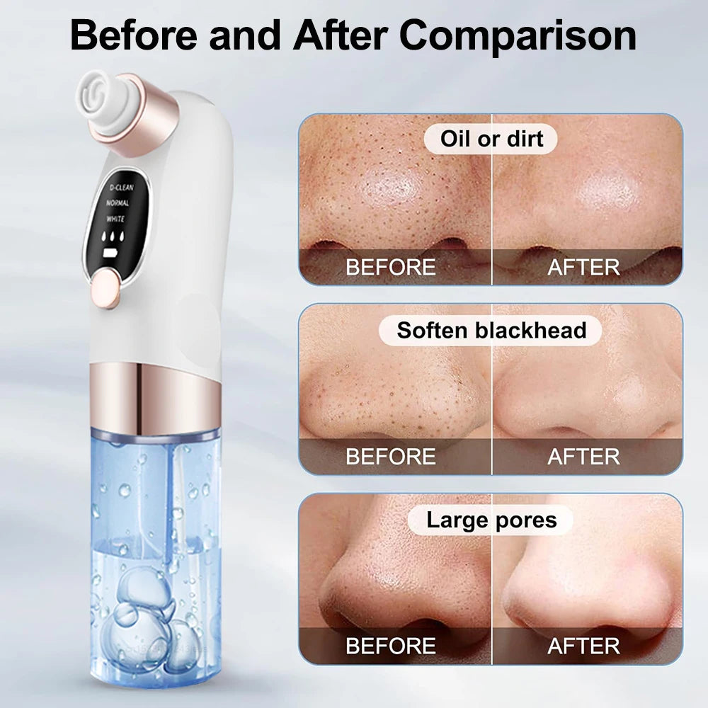Electric Blackhead Remover – Deep Pore Cleaner